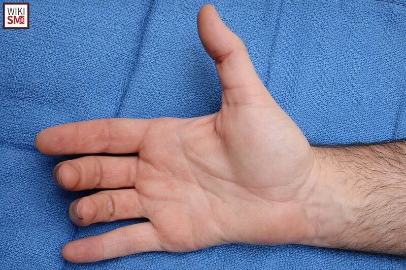 File:Masses sign ulnar nerve.jpeg