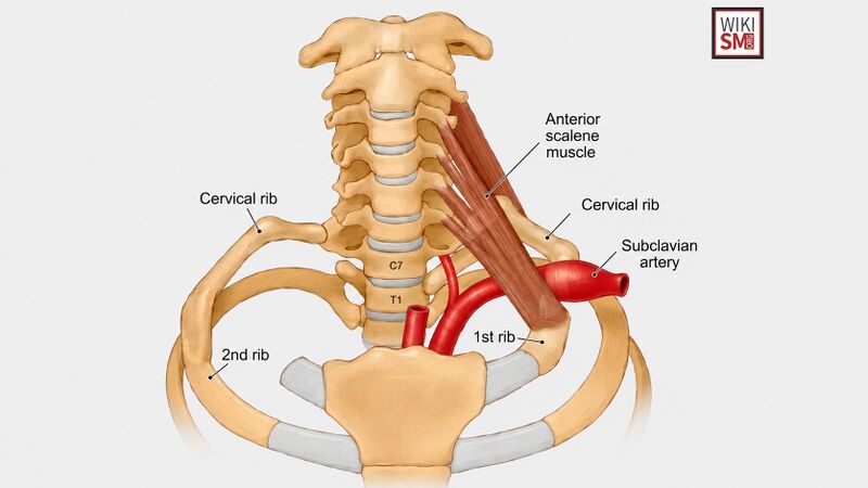 File:Cervical rib anatomy.jpeg