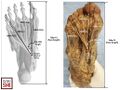 Schematic diagram of the foot showing foot length and MKH-landmark length measurements. Gdp-Ct, great toe distal phalanx-calcaneus tuberosity; MKH-Gdp, Master Knot of Henry-great toe distal phalanx; MKH-FHLi, Master Knot of Henry-FHL insertion; MKH-Lt, Master Knot of Henry-little toe distal phalanx; MKH-FDLi, Master Knot of Henry-FDL little toe insertion; FHL, flexor hallucis longus; FDL, flexor digitorum longus.[2]