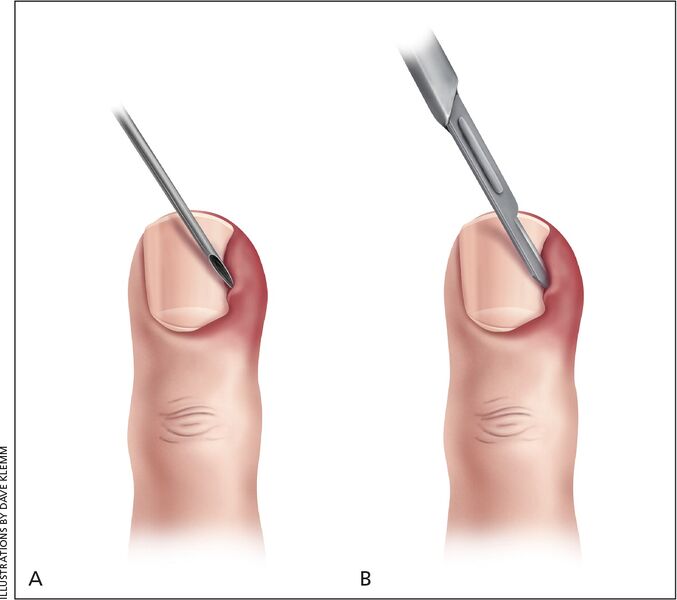 File:Drainage of acute paronychia.jpg