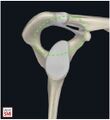 Superior Shoulder Suspensory Complex[1]