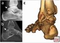 Os trigonum on (a) Lateral foot radiograph; (b) 2D CT; (c) 3D CT[2]