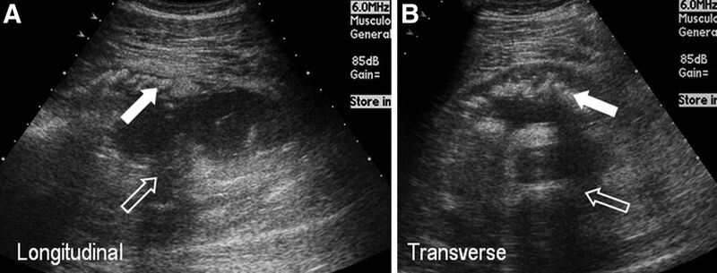 File:Thigh ultrasound myositis ossificans.jpeg