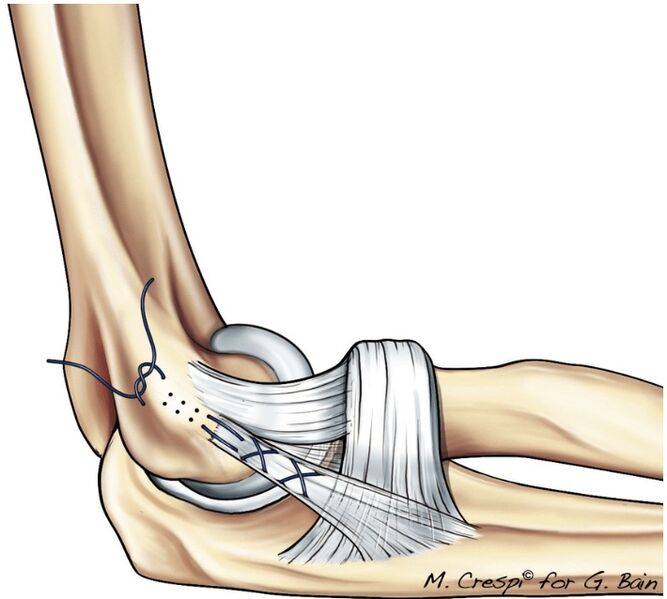 File:Elbow LCL surgical repair.jpg