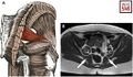 Anatomy of the piriformis muscle. (A) Anatomic illustration shows the location and course of the piriformis muscle (red area). (B) 3-T axial T1-weighted MR image shows the left and right piriformis muscle (white arrows) and the proximal neurovascular bundles (circles) containing the sciatic nerve.[1]