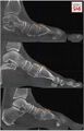The dorsal translation of the first metatarsal at the first tarsometatarsal joint was defined as a step-off or discontinuation of the curvature along of the plantar or dorsal borders of the medial cuneiform and the first metatarsal on parasagittal cut at the mediolateral center of the TMT joint[3]