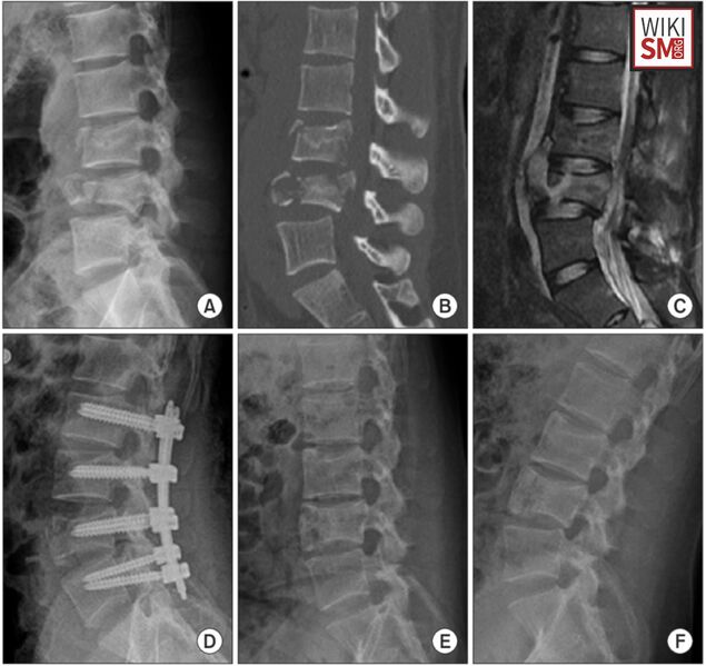 File:L3 L4 burst fracture.jpeg