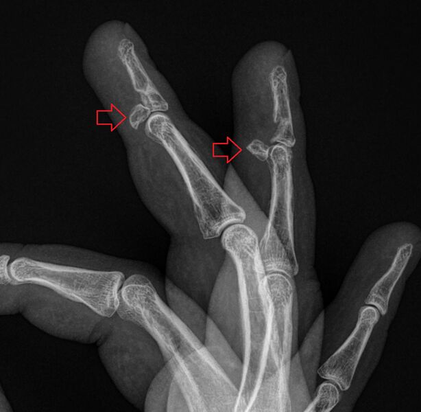 File:Hand XR Jersey Finger.jpg