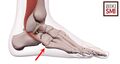Peroneal tendon tear
