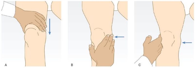 File:Bulge sign knee.jpg