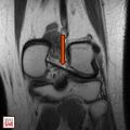 MRI of wrisberg annotated[2]