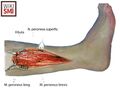 Anatomy of the lateral lower leg with marked peroneus brevis muscle[1]