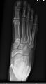 Anterior-Posterior