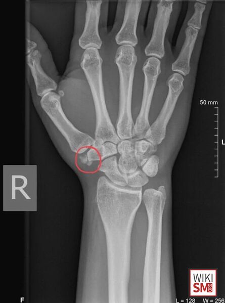 File:Os Paratrapezium xray.jpeg