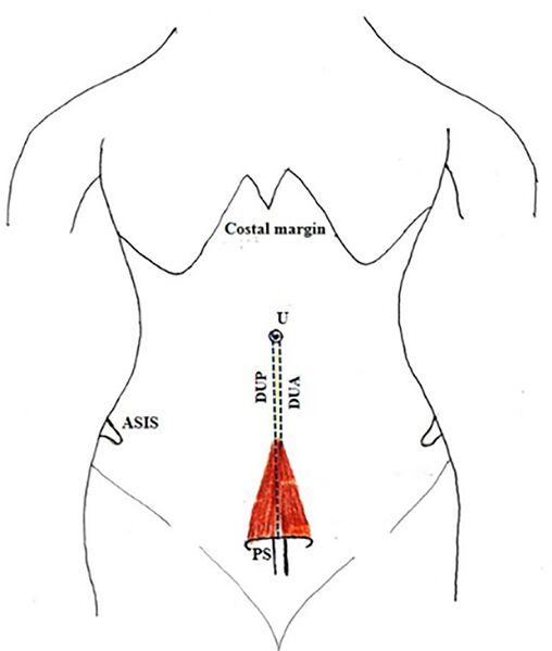 File:Pyramidalis muscle.jpg