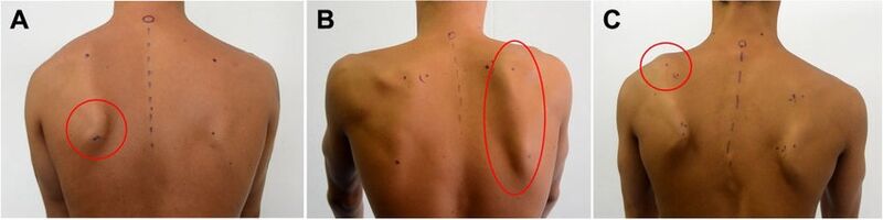 File:Scapular dyskinesis clinical.jpg