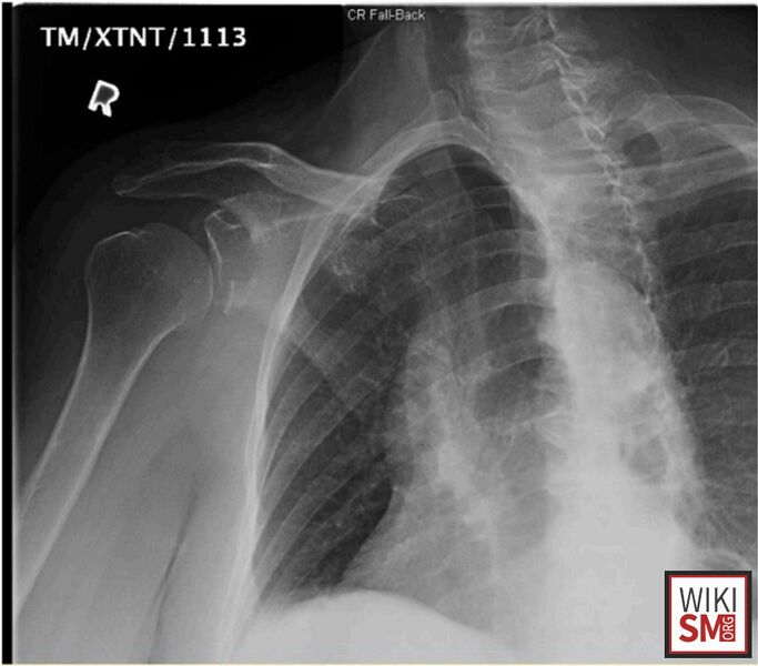 File:XR Bankart Lesion.jpg