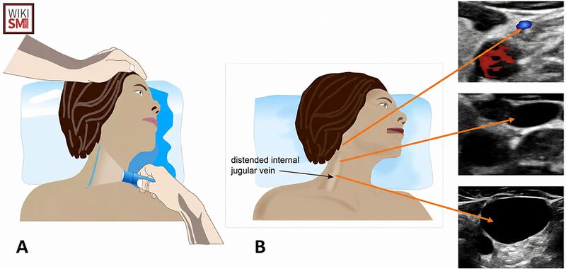 File:Jugular venous distension modified.jpeg