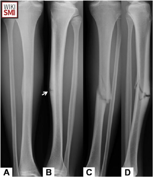 File:Tibial stress fracture progression.jpeg