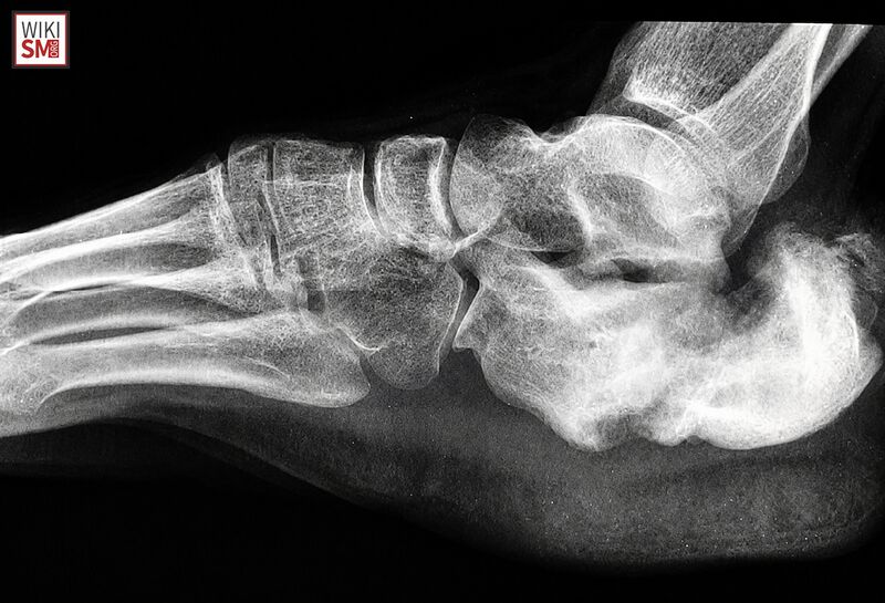 File:Calcaneus fracture nonunion xray.jpeg