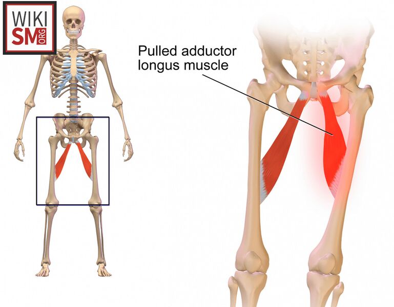 File:Strained adductor longus.jpeg
