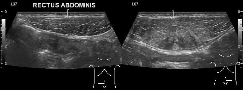 File:US rectus abdominis strain.jpg