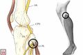 Common peroneal nerve entrapment. Left -entrapment of the common peroneal nerve (CPN) at the peroneus longus (PL) peroneal tunnel (circle) near the fibular neck (circle). Right -sensory distribution of common peroneal nerve entrapment[2]
