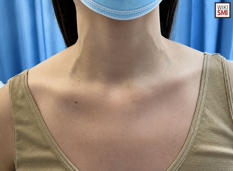 File:Jugular venous distension JVD.jpeg