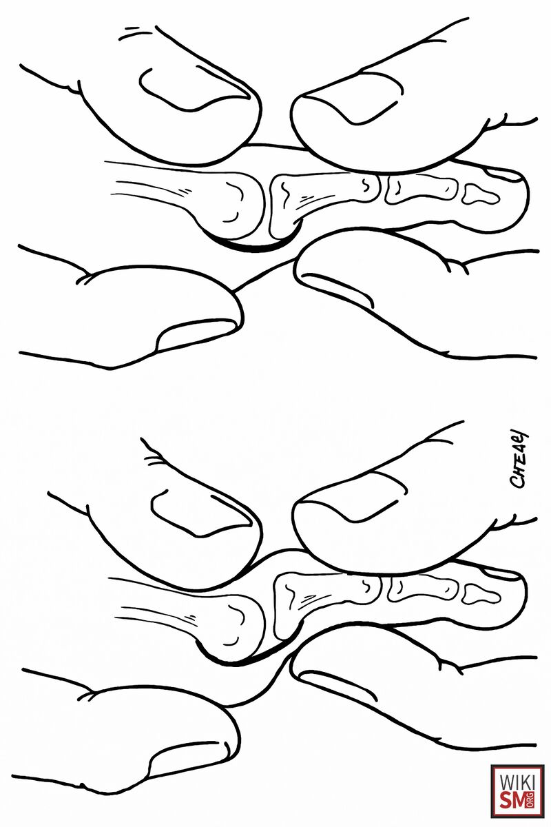 Lachman Test of the Great Toe - Turf Toe - WikiSM (Sports Medicine Wiki)