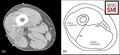(a) Radiotherapy planning scan through the lower thigh, below the adductor canal. The main muscle groups can be seen, and sartorius is marked 'S'. The femoral vessels lie immediately posterior to the intermuscular septum within the posterior compartment and are marked 'AþV'.[3]