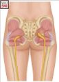 Illustration of displaying the release of the piriformis muscle. On the left side of the image, the sciatic nerve is displayed in its typical location below the piriformis muscle. On the right side of the image, the sciatic nerve is shown decompressed after cutting of the piriformis muscle[3]