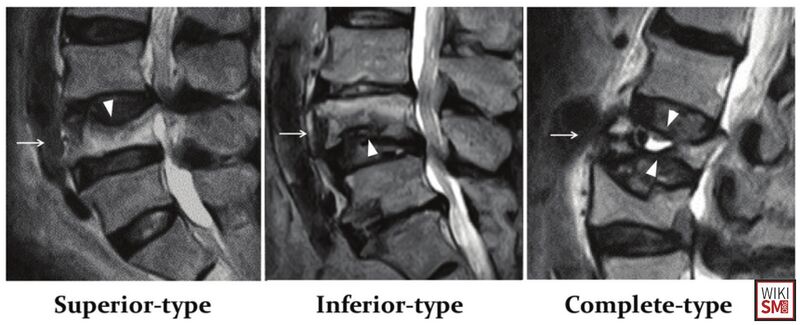 File:MRI burst fracture.jpeg