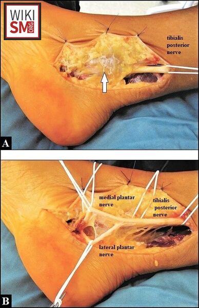 File:Tarsal tunnel surgery.jpeg