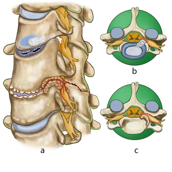 File:Cervical spondylotic radiculopathy.jpg
