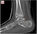 Lateral view of the ankle, with arrow indicating the os trigonum[3]