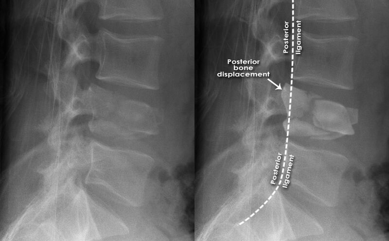 File:Burst fracture xray.jpg