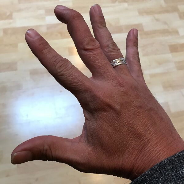 File:Mallet finger.jpg