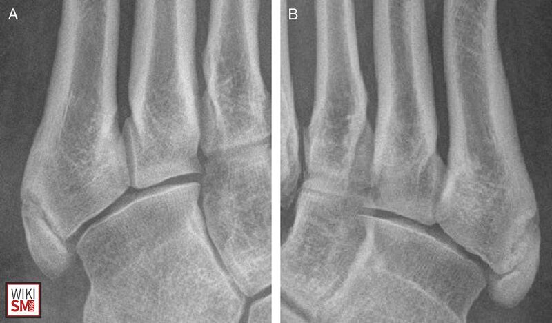 File:Os Vesalianum bilateral xray.jpeg