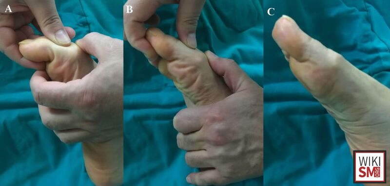 File:Trigger toe clinical example.jpeg