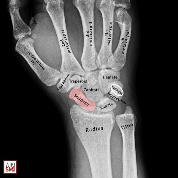 File:Scaphoid anatomy xray.jpeg