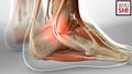 Peroneus longus tendon split
