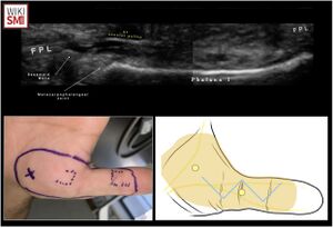 Flexor Pollicis Longus Rupture - WikiSM (Sports Medicine Wiki)