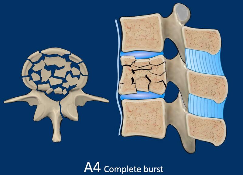 File:Complete burst fracture.jpg