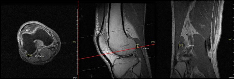 File:Knee MRI fabella syndrome.jpg
