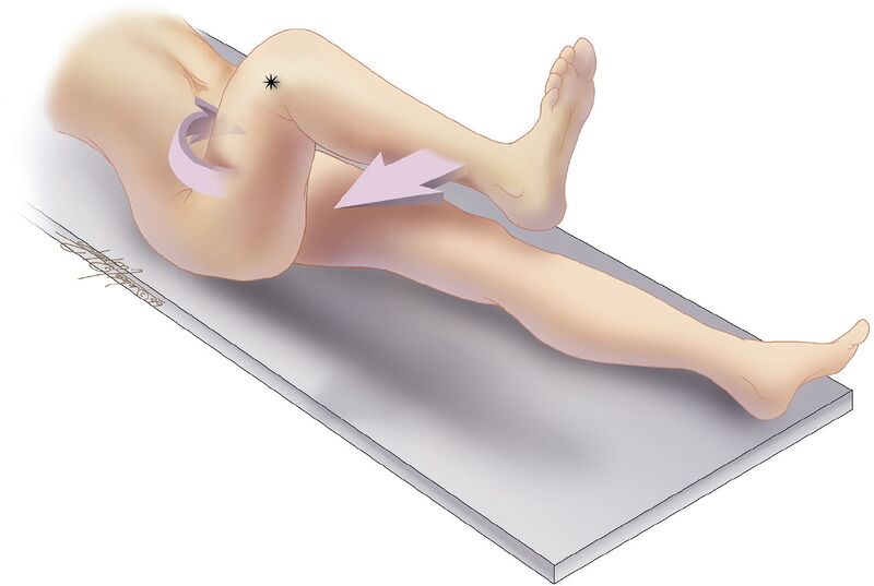 File:Obturator-internus-sign-for-acute-appendicitis.jpg