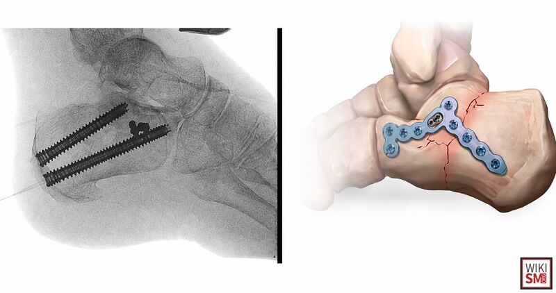 File:Calcaneus fracture surgery.jpeg