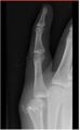 Oblique radiograph demonstrating volar dislocation of the metacarpophalangeal joint[1]