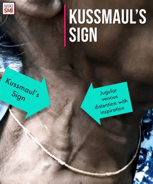 File:Kussmauls sign.jpeg