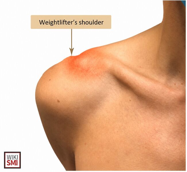 File:Weightlifters shoulder.jpeg