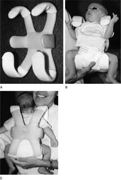 File:Rosen splint.jpg